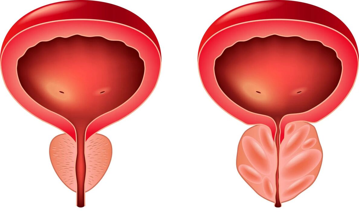 Normal and diseased prostate