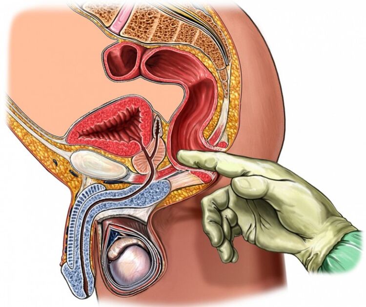 Prostate massage cure prostatitis